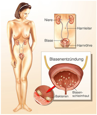 Cranberry gegen Blasenentzündung & Harnwegsinfekt.